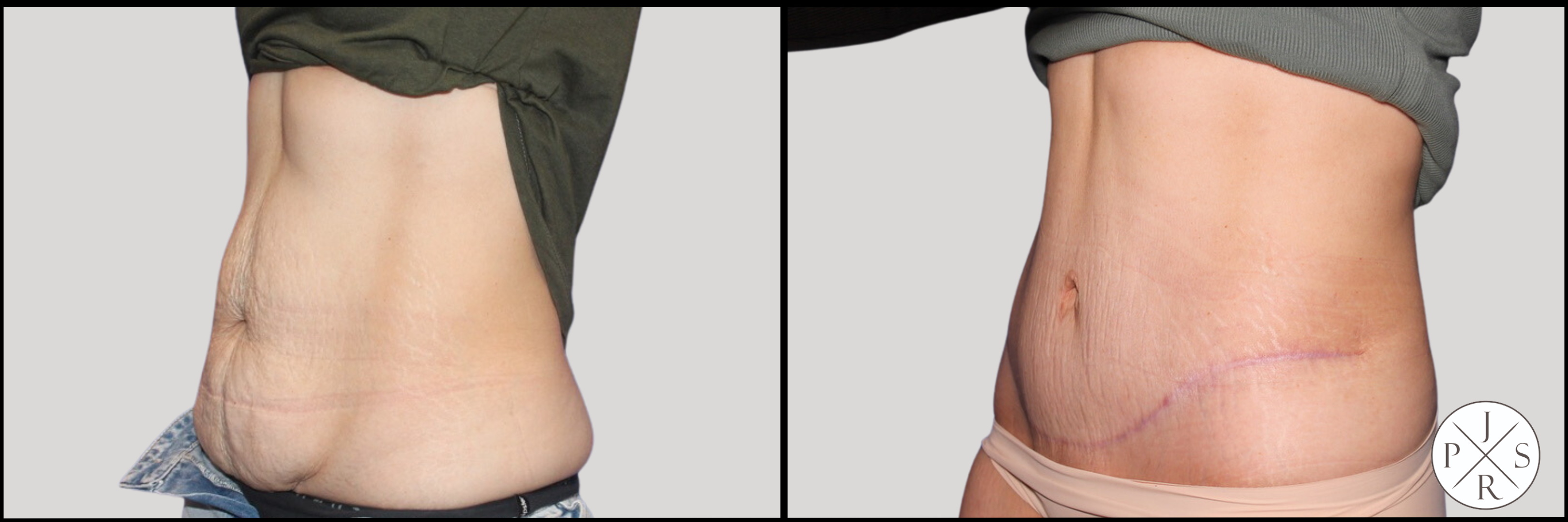 Abdominoplasty Before & After Image